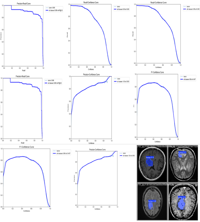 صورة مشروع A Hybrid System Combining Computer Vision (YOLOv11) and Autonomous Robotics (RoboDK) for Safe Path Planning and Brain Tumor Ablation